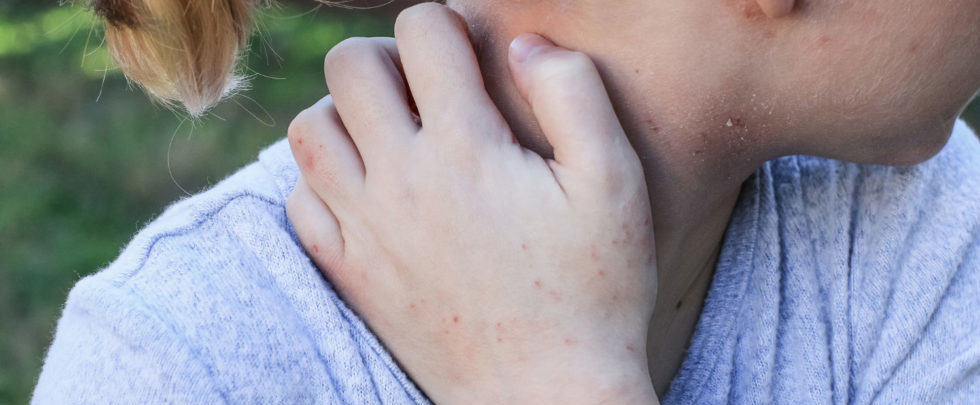 Eczema-prone kids – not just itchy on the outside!
