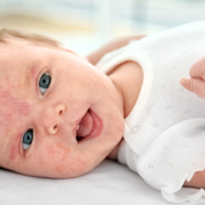 baby with eczema on face